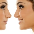 Most Popular Rhinoplasty Surgeon in Beverly Hills CA